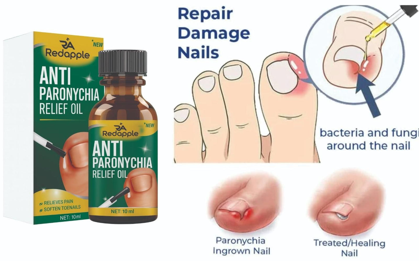 Anti Paronychia Relief Oil 🔥(Buy 1 Get 1 Free)🔥 (Pack Of 2)